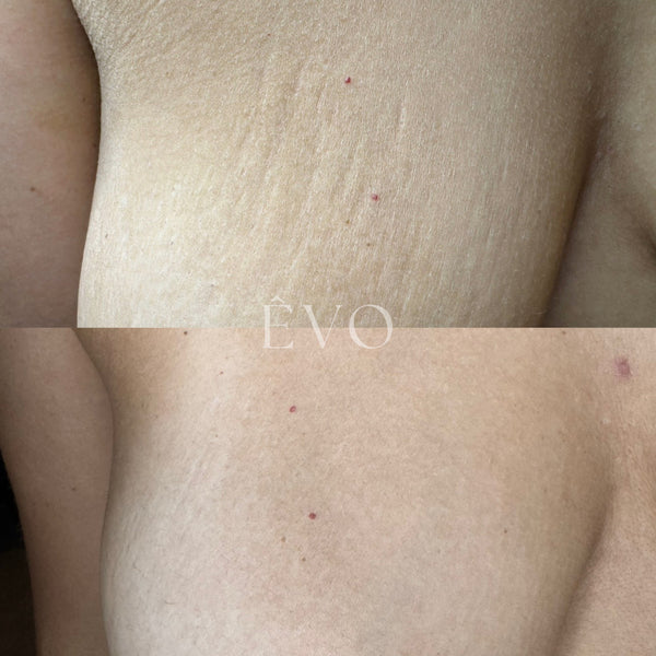 Breast Stretchmarks Revision