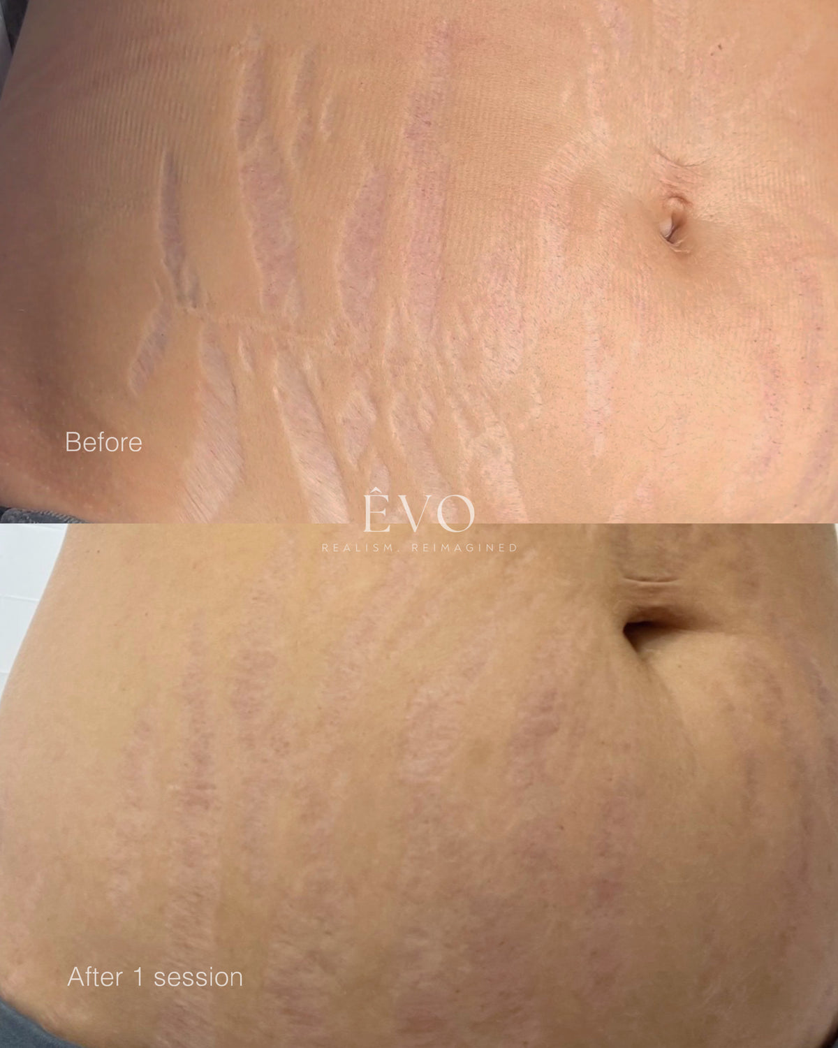 Inkless Stretch Mark & Scar Revision