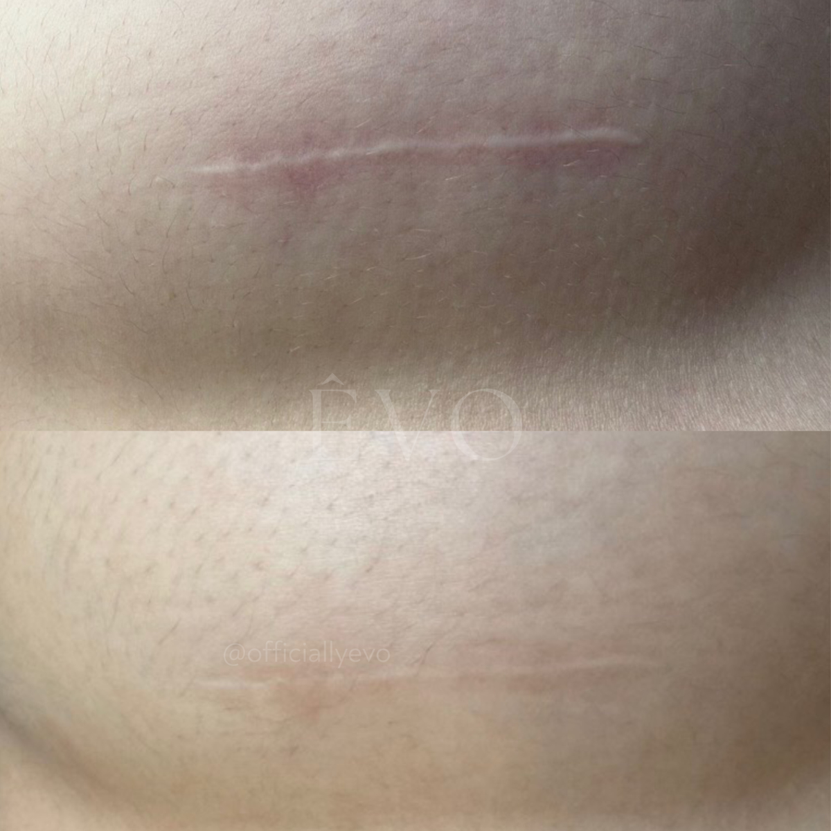 Stretchmarks & Scar Revision