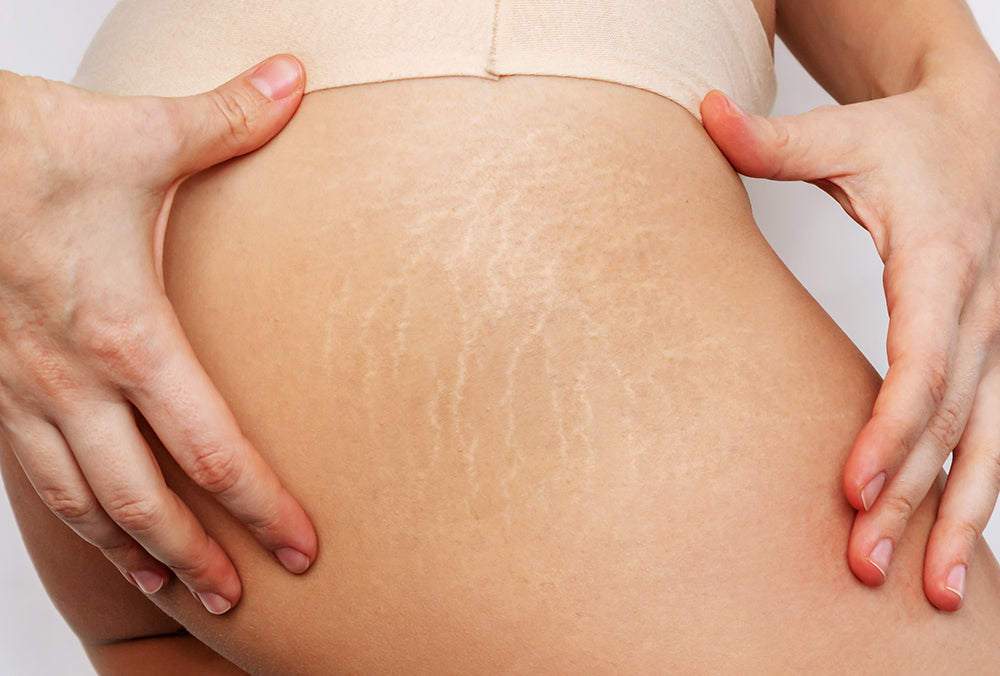 Stretch Marks + Scars Rejuvenation